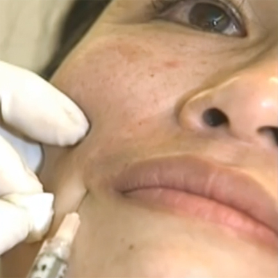 胶原蛋白祛除法令纹