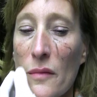 真实脸颊填充泪槽