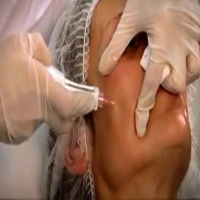 Restylane Vital填充面部2