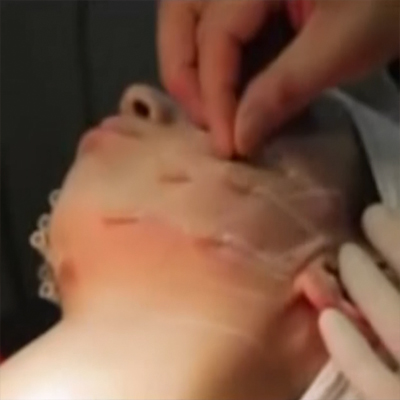 面部埋线提升紧致