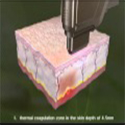 3D演示超声刀拉皮