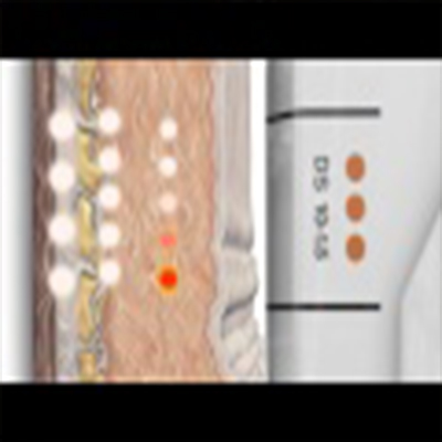 超声刀各皮层的治疗