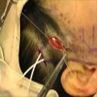 外科拉皮手术提升