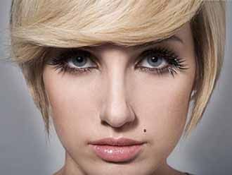 激光点痣的优势如何