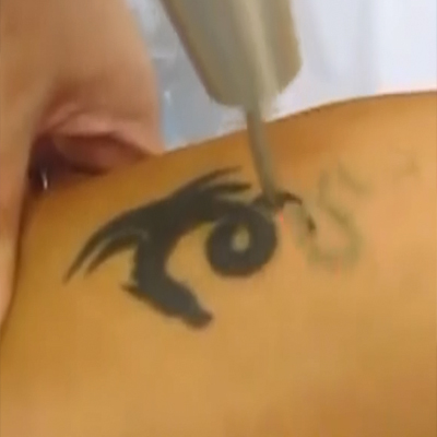 激光祛除纹身