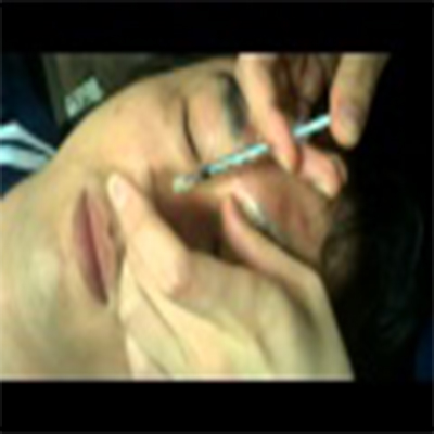 肉毒杆菌消除眉间纹