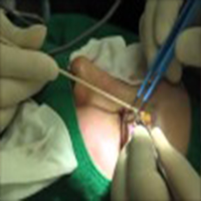 外科手术埋线重睑