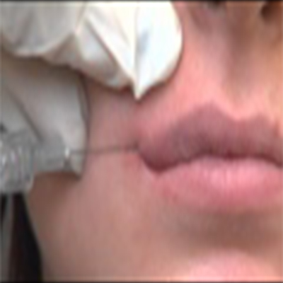 唇部的丰满与塑造