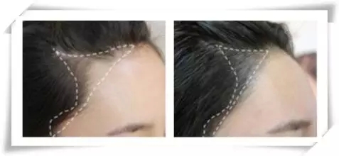 浅谈半永久定妆美容