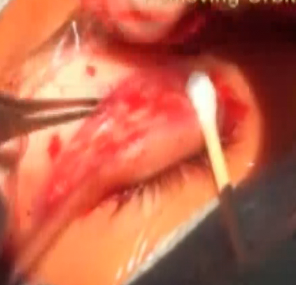 双眼皮外科手术