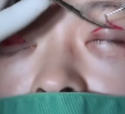 外科手术重睑全切开法