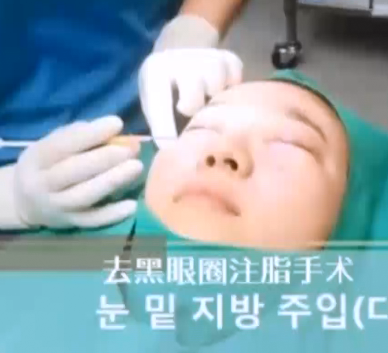 自体脂肪去黑眼圈