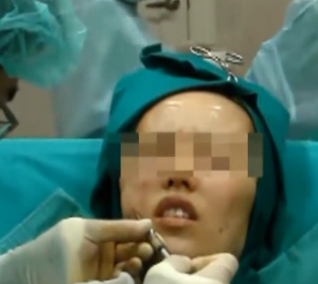 自体脂肪移植脸部填充