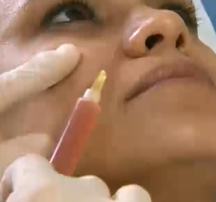 PRP消除黑眼圈与鼻唇沟