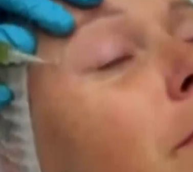 PRP注射消除鱼尾纹