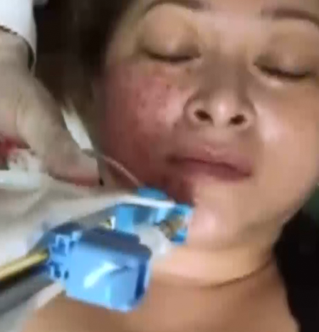 PRP全面部注射美容