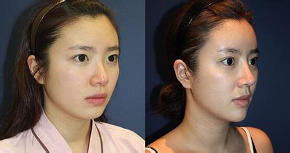 微整形不建议做的部位有哪些