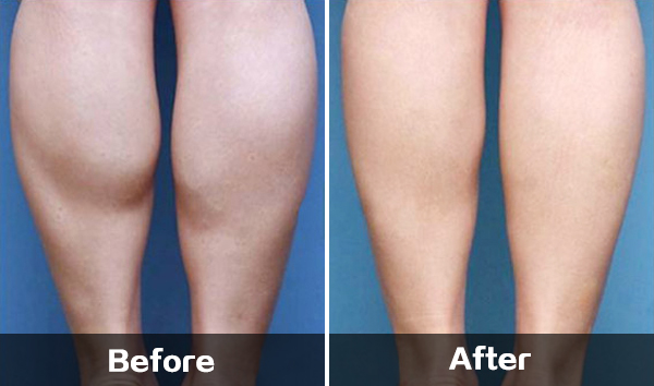 微整形不建议做的部位有哪些