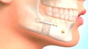 下颌后缩矫正术与牙齿正畸术