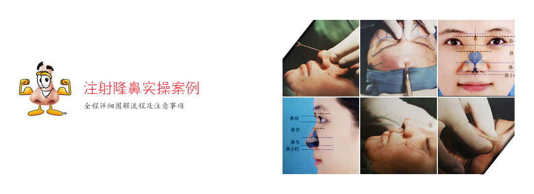 注射隆鼻实操案例