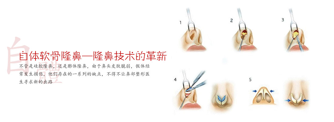 详解自体软骨隆鼻